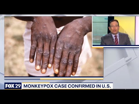 Monkeypox leads to "puss filled sores" like in Revelation 16:2